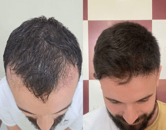 Harmony Transplante Capilar - Antes e Depois