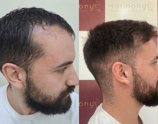 Harmony Transplante Capilar - Antes e Depois