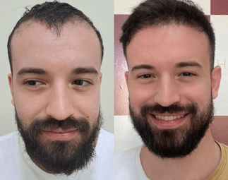 Harmony Transplante Capilar - Antes e Depois