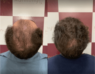 Harmony Transplante Capilar - Antes e Depois