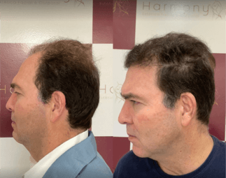 Harmony Transplante Capilar - Antes e Depois