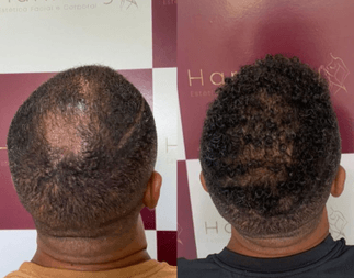 Harmony Transplante Capilar - Antes e Depois