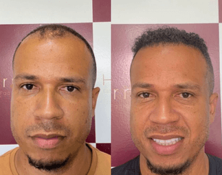 Harmony Transplante Capilar - Antes e Depois