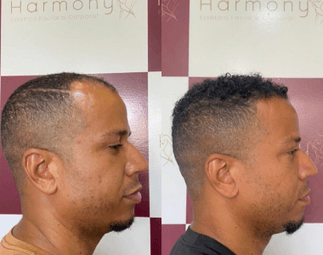 Harmony Transplante Capilar - Antes e Depois