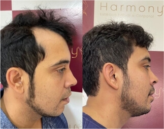 Harmony Transplante Capilar - Antes e Depois