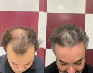 Harmony Transplante Capilar - Antes e Depois