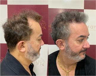 Harmony Transplante Capilar - Antes e Depois