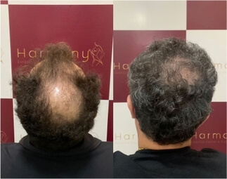 Harmony Transplante Capilar - Antes e Depois