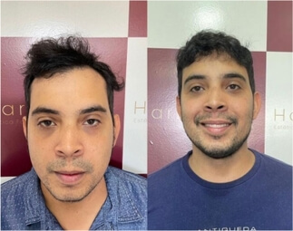 Harmony Transplante Capilar - Antes e Depois