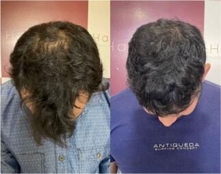 Harmony Transplante Capilar - Antes e Depois