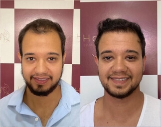 Harmony Transplante Capilar - Antes e Depois