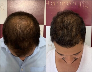 Harmony Transplante Capilar - Antes e Depois