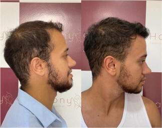 Harmony Transplante Capilar - Antes e Depois