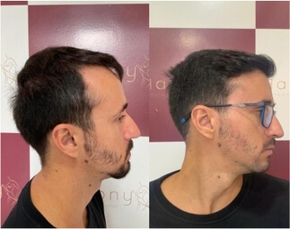 Harmony Transplante Capilar - Antes e Depois