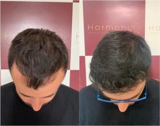 Harmony Transplante Capilar - Antes e Depois