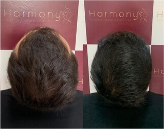 Harmony Transplante Capilar - Antes e Depois