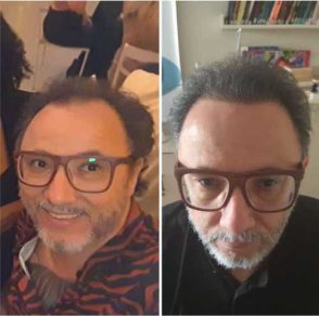 Harmony Transplante Capilar em Americana